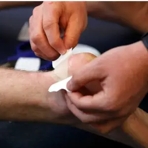  Treatment of Basketball Blisters