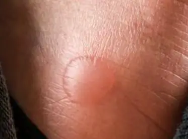 Blisters On Sides Feet