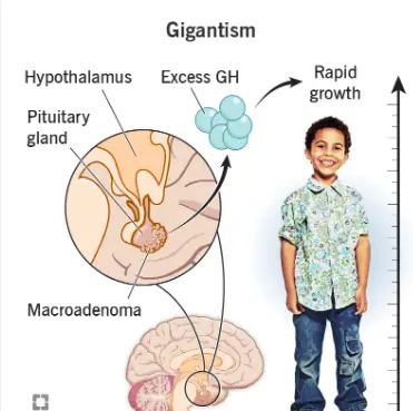 Gigantism growth