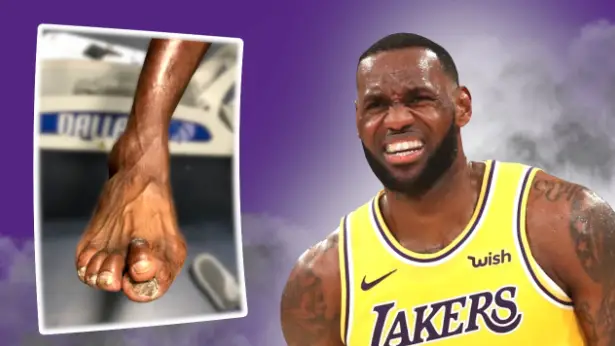 Basketball Players Do For Bunions?