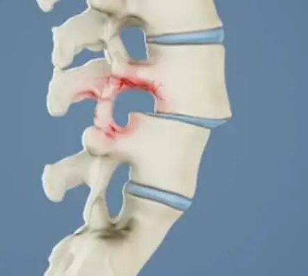 Spondylolisthesis in Basketball