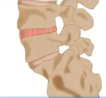 Spondylolysis in Basketball